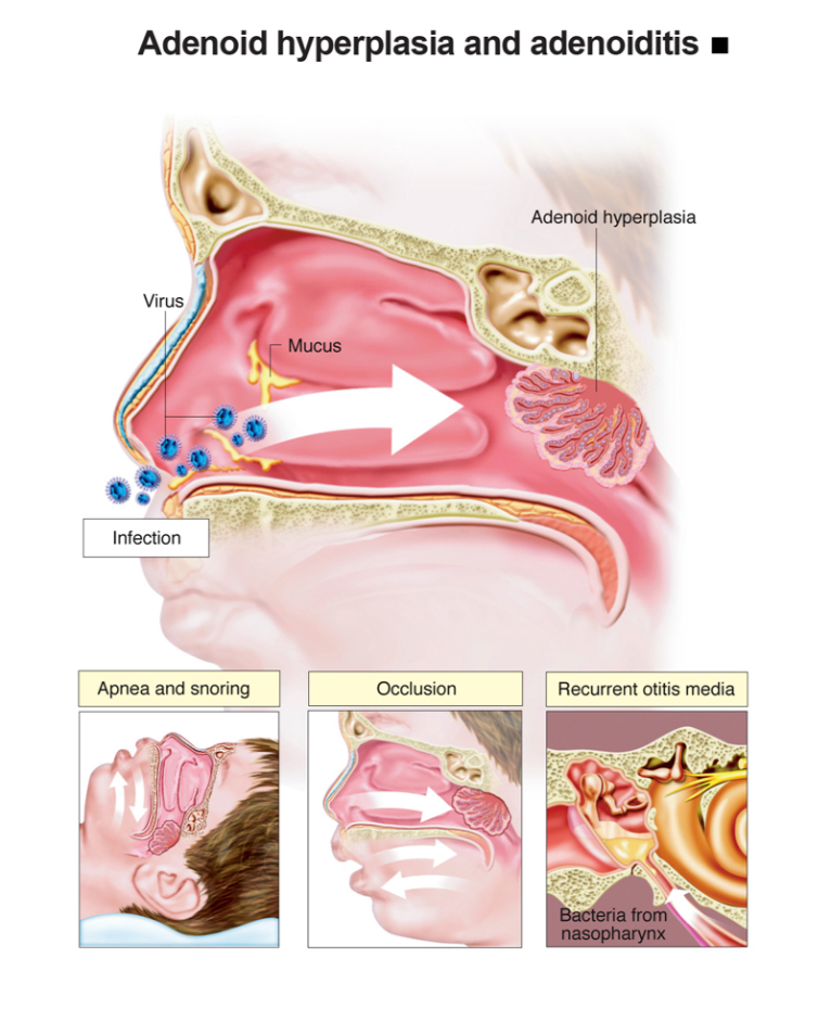 Infografis adenoiditis